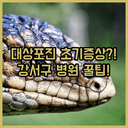 대상포진 초기 증상과 강서구 치료 병원 선택 방법
